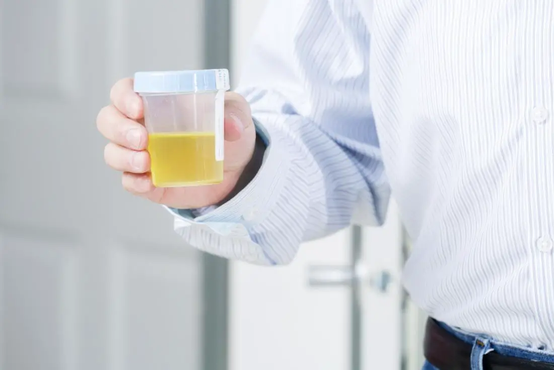 O Que é Células Epiteliais No Exame De Urina